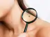 Keep an eye on your skin: 5 ways to identify if you have melanoma